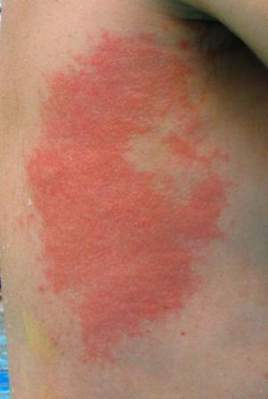 coral sting...OUCH